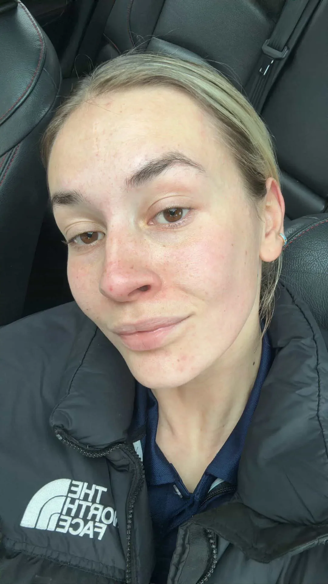 Sarah's skin after 8 weeks of CYOU